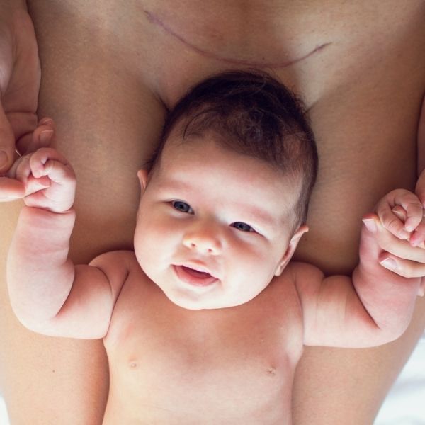 Die Kaiserschnittnarbe - Pflege & Heilung - MyClarella